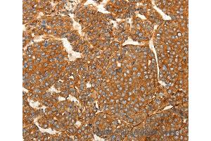 Immunohistochemistry of Human lung cancer using SFRP1 Polyclonal Antibody at dilution of 1:80 (SFRP1 Antikörper)