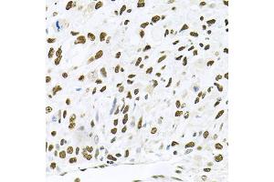 Immunohistochemistry of paraffin-embedded human lung cancer using MAPK8 antibody (ABIN5970116) at dilution of 1/100 (40x lens). (JNK Antikörper)