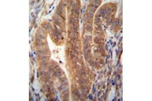 Immunohistochemistry analysis in formalin fixed and paraffin embedded human uterus tissue reacted with KIAA1644 antibody (N-term) followed which was peroxidase conjugated to the secondary antibody and followed by DAB staining. (SHISAL1/KIAA1644 Antikörper  (N-Term))