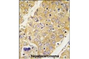 Formalin-fixed and paraffin-embedded human hepatocarcinoma tissue reacted with Dtnbp1 Antibody (C-term) (ABIN389170 and ABIN2839336) , which was peroxidase-conjugated to the secondary antibody, followed by DAB staining. (DTNBP1 Antikörper  (C-Term))