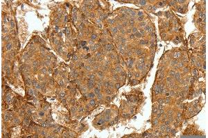 Immunohistochemistry of Human breast cancer using COL4A1 Polyclonal Antibody at dilution of 1:30 (COL4A1 Antikörper)