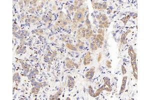 Immunohistochemistry analysis of paraffin-embedded human liver cancer using PERK Polyclonal Antibody at dilution of 1:400. (PERK Antikörper)
