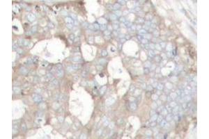 Immunohistochemistry analyzes of Cortactin antibody in paraffin-embedded human prostate carcinoma tissue. (Cortactin Antikörper)