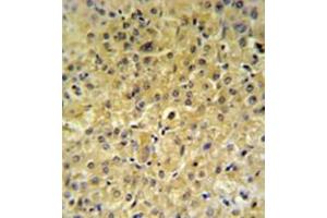 Immunohistochemistry analysis in formalin fixed and paraffin embedded hepatocarcinoma reacted with INSC Antibody (Center) followed by peroxidase conjugation of the secondary antibody and DAB staining. (INSC Antikörper  (Middle Region))
