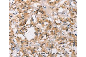 Immunohistochemistry of Human thyroid cancer using MARC1 Polyclonal Antibody at dilution of 1:40 (MOSC1 Antikörper)