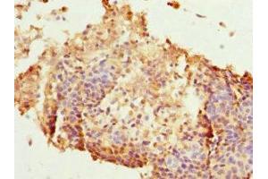Immunohistochemistry of paraffin-embedded human cervical cancer using ABIN7165626 at dilution of 1:100 (HEXIM1 Antikörper  (AA 210-359))