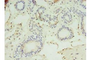 Immunohistochemistry of paraffin-embedded human breast cancer using ABIN7158756 at dilution of 1:100 (LYPLAL1 Antikörper  (AA 2-237))