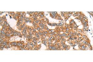 Immunohistochemistry of paraffin-embedded Human liver cancer tissue using CDON Polyclonal Antibody at dilution of 1:65(x200) (CDON Antikörper)