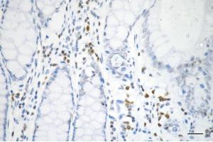 Immunohistochemistry was performed on paraffin-embedded human sigmoid colon carcinoma using histone H3 (tri methyl K27) antibody (ABIN7798967), 1:200). (Rekombinanter Histone 3 Antikörper  (H3K27me3))
