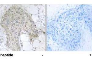 Immunohistochemical analysis of paraffin-embedded human breast carcinoma tissue using PPP1R2 polyclonal antibody . (PPP1R2 Antikörper  (Ser120, Ser121))