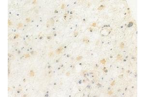 ABIN6264878 and ABIN6272422 at 1/100 staining human astrocytoma by IHC-P. (RTCD1 Antikörper  (C-Term))