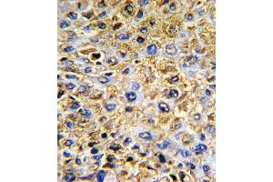 Formalin-fixed and paraffin-embedded human hepatocarcinoma with DCN Antibody , which was peroxidase-conjugated to the secondary antibody, followed by DAB staining. (Decorin Antikörper  (AA 122-150))
