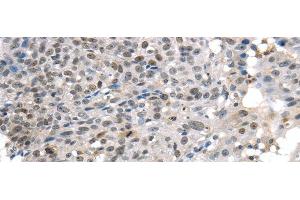 Immunohistochemistry of paraffin-embedded Human breast cancer tissue using KDM5C Polyclonal Antibody at dilution 1:45 (KDM5C Antikörper)