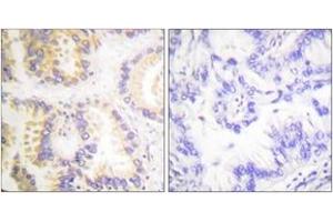Immunohistochemistry analysis of paraffin-embedded human lung carcinoma, using Caspase 8 (Phospho-Ser347) Antibody. (Caspase 8 Antikörper  (pSer347))