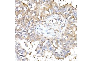 Immunohistochemistry of paraffin-embedded human breast cancer using HINT1 Rabbit mAb (ABIN7267663) at dilution of 1:50 (40x lens). (HINT1 Antikörper)