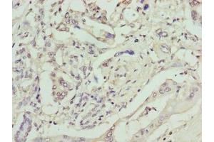 Immunohistochemistry of paraffin-embedded human pancreatic cancer using ABIN7161374 at dilution of 1:100 (GPM6B Antikörper  (AA 1-64))