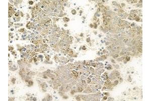 ABIN6259124 and ABIN6275293 at 1/100 staining human melanoma by IHC-P.