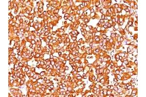 Formalin-fixed, paraffin-embedded human melanoma stained with VIM antibody (SPM576).