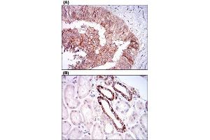 Immunohistochemical staining of human ovarian cancer tissues (A) and kidney tissues (B) with TIE1 monoclonal antibody, clone 8D12D2  at 1:200-1:1000 dilution. (TIE1 Antikörper  (AA 385-607))