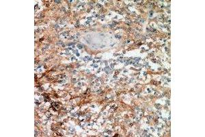 Immunohistochemical analysis of Nanos 1 staining in human breast cancer formalin fixed paraffin embedded tissue section. (Nanos Homolog 1 Antikörper)