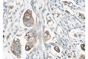 ABIN6267549 at 1/100 staining human Stomach cancer tissue sections by IHC-P. (STAT5B Antikörper  (pSer731))