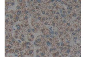 IHC-P analysis of Human Liver Cancer Tissue, with DAB staining. (Cytokeratin 1 Antikörper  (AA 487-644))