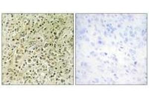 Immunohistochemistry analysis of paraffin-embedded human prostate carcinoma tissue, using RHG07 antibody. (DLC1 Antikörper)