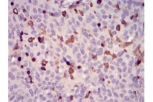 Immunohistochemical analysis of paraffin-embedded ovarian cancer tissues using WAS mouse mAb with DAB staining. (WASP Antikörper  (AA 57-170))