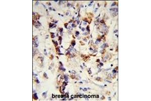 Formalin-fixed and paraffin-embedded human breast carcinoma reacted with SKIV2L2 Antibody (Center), which was peroxidase-conjugated to the secondary antibody, followed by DAB staining. (MTR4 Antikörper  (AA 237-263))