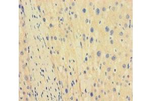 Immunohistochemistry of paraffin-embedded human liver cancer using ABIN7171563 at dilution of 1:100 (TBPL1 Antikörper  (AA 1-185))