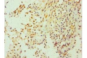 Immunohistochemistry of paraffin-embedded human breast cancer using ABIN7152857 at dilution of 1:100 (FGFBP1 Antikörper  (AA 24-234))