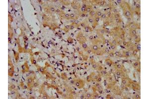 IHC image of ABIN7145800 diluted at 1:800 and staining in paraffin-embedded human liver cancer performed on a Leica BondTM system. (BAZ2B Antikörper  (AA 139-240))