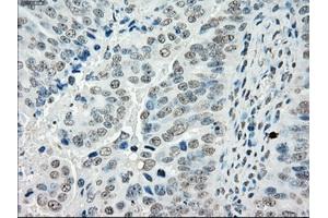 Immunohistochemical staining of paraffin-embedded Adenocarcinoma of colon tissue using anti-PORmouse monoclonal antibody. (POR Antikörper)