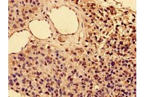 Immunohistochemistry of paraffin-embedded human glioma using ABIN7156842 at dilution of 1:100 (CD25 Antikörper  (AA 22-185))