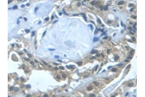 Detection of TGFa in Human Thyroid cancer Tissue using Monoclonal Antibody to Transforming Growth Factor Alpha (TGFa) (TGFA Antikörper  (AA 24-98))