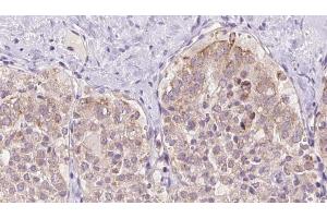 ABIN6273341 at 1/100 staining Human thyroid cancer tissue by IHC-P. (USP33 Antikörper  (Internal Region))