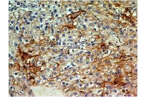 Immunohistochemical analysis of CD73  in renal cell carcinoma using CD73 antibody (Clone: ABM40E2) at 5 µg/ml. (CD73 Antikörper  (AA 145-346))