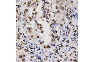 Immunohistochemistry of paraffin-embedded human lung cancer tissue using H3R17me2a antibody at dilution of 1:200 (x400 lens) (Histone 3 Antikörper  (H3R17me2a))