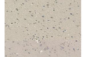 ABIN6264172 and ABIN6273294 at 1/100 staining human glioblastoma by IHC-P. (PHF11 Antikörper  (C-Term))