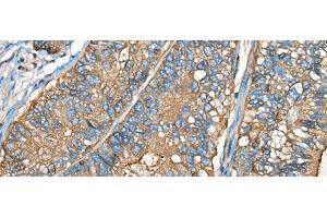 Immunohistochemistry of paraffin-embedded Human gastric cancer tissue using CEACAM8 Polyclonal Antibody at dilution of 1:30(x200) (CEACAM8 Antikörper)