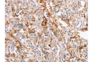 The image on the left is immunohistochemistry of paraffin-embedded Human gastric cancer tissue using ABIN7131059(SIGLEC9 Antibody) at dilution 1/30, on the right is treated with fusion protein. (SIGLEC9 Antikörper)
