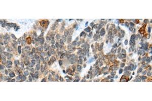 Immunohistochemistry of paraffin-embedded Human thyroid cancer tissue using ATRX Polyclonal Antibody at dilution of 1:50(x200) (ATRX Antikörper)
