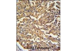 KRT19 Antibody (C-term) (ABIN389327 and ABIN2839443) IHC analysis in formalin fixed and paraffin embedded human Lung carcinoma followed by peroxidase conjugation of the secondary antibody and DAB staining. (Cytokeratin 19 Antikörper  (C-Term))