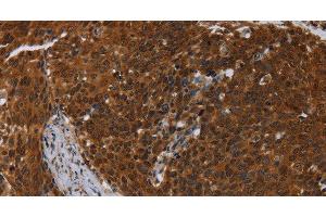 Immunohistochemistry of paraffin-embedded Human cervical cancer using MCHR1 Polyclonal Antibody at dilution of 1:30 (MCHR1 Antikörper)