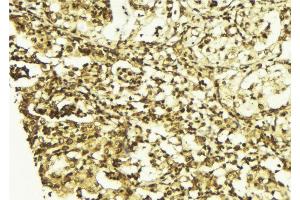 ABIN6267513 at 1/100 staining Human breast cancer tissue by IHC-P. (STAT5 A/B Antikörper  (pSer725, pSer730))