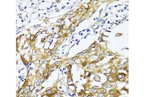 Immunohistochemistry of paraffin-embedded Human liver cancer using GLUT4 Polyclonal Antibody at dilution of 1:100 (40x lens). (GLUT4 Antikörper)