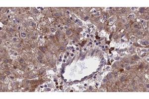 ABIN6273966 at 1/100 staining Human liver cancer tissue by IHC-P. (OR1F1 Antikörper  (C-Term))