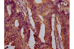 IHC image of ABIN7174121 diluted at 1:400 and staining in paraffin-embedded human colon cancer performed on a Leica BondTM system.