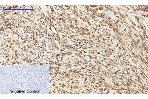 Immunohistochemical analysis of paraffin-embedded human uterus cancer tissue.