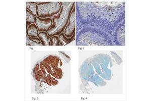 Formalin Fixed Paraffin Embedded (FFPE) human colon adenocarcinoma tissues (Fig. (PCNA Antikörper)